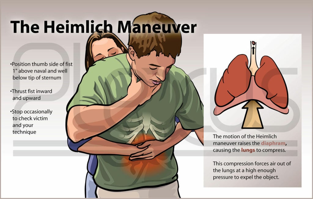 Learn the Heimlich Maneuver, a Friend of Mine Choked To