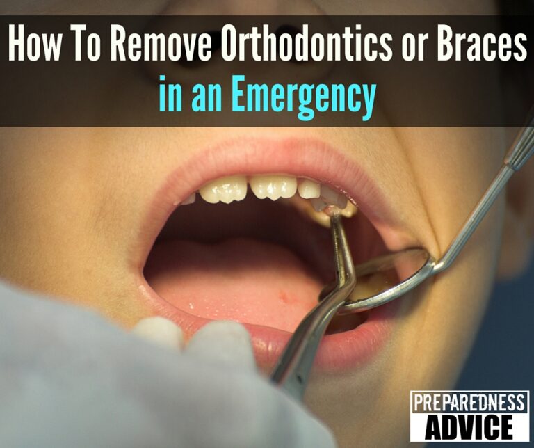 How To Remove Orthodontics or Braces in an Emergency PREPAREDNESS ADVICE