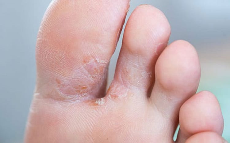 Can Fungal Infections be Treated by Antibiotics?